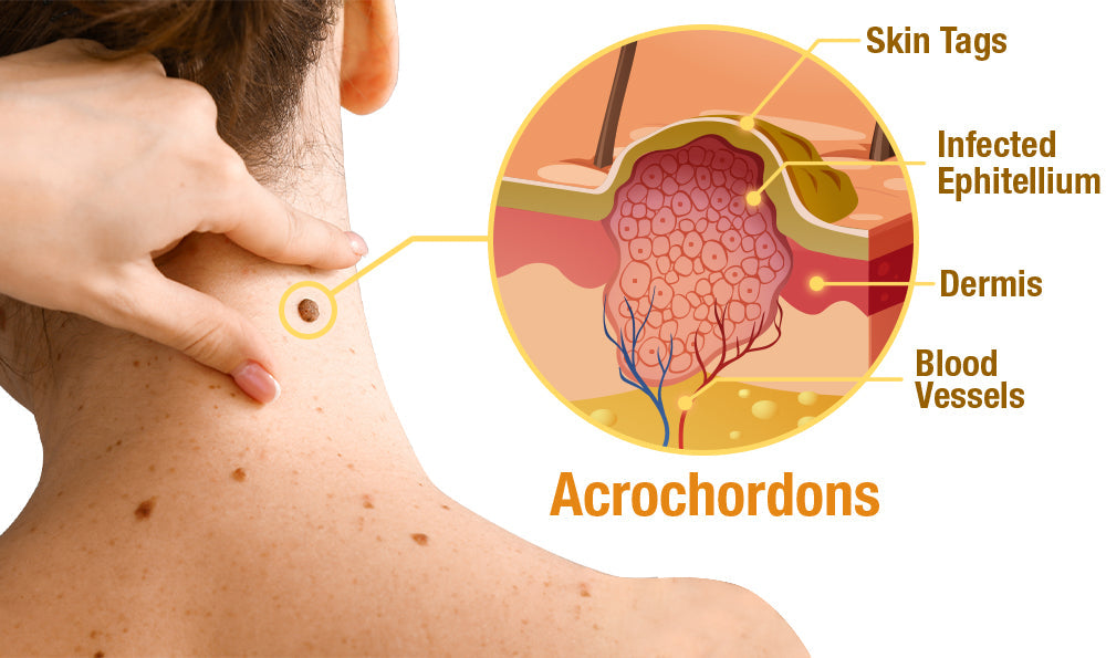 🐝BBOJI™ TagRecede Apitoxin Mole Removal Cream