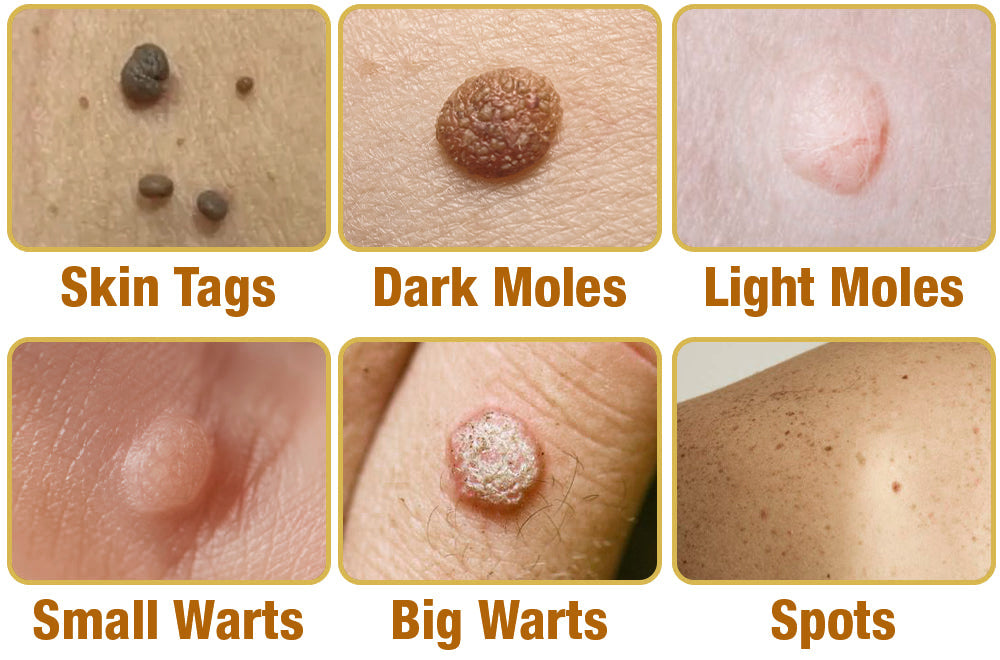 🐝BBOJI™ TagRecede Apitoxin Mole Removal Cream