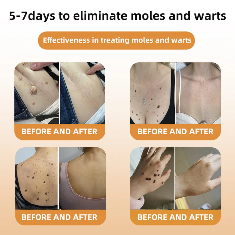 🐝BBOJI™ TagRecede Apitoxin Mole Removal Cream