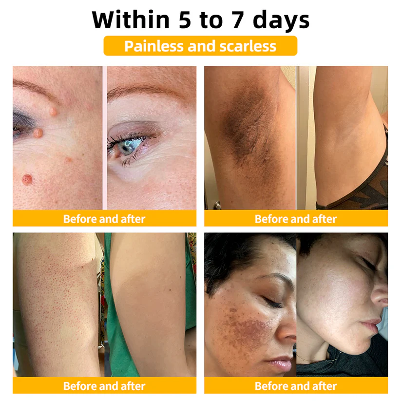 🐝BBOJI™ TagRecede Apitoxin Mole Removal Cream