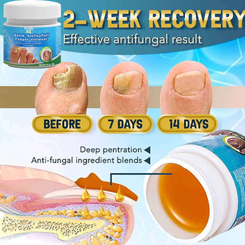 HZA™ 5X Quick-healing Nail Fungus Ointment