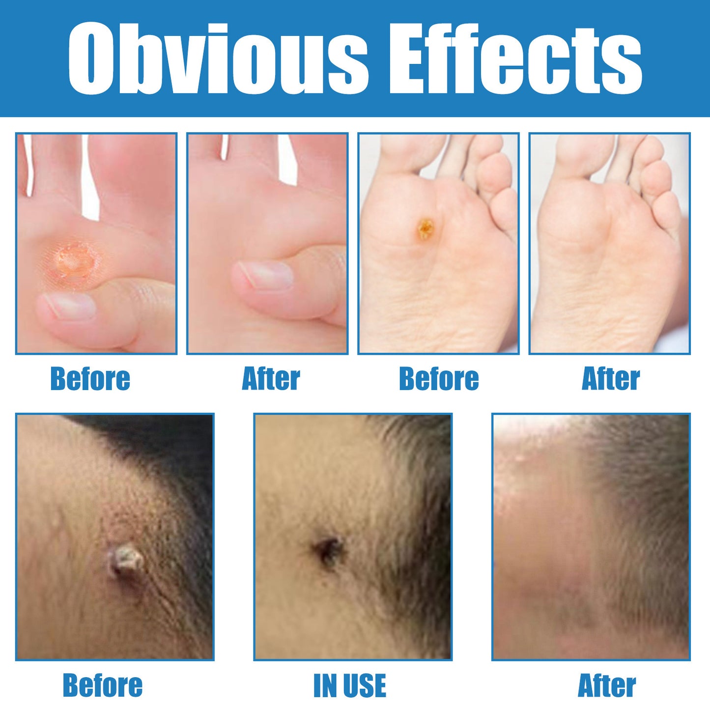 HZA ® Warts Remover Stick