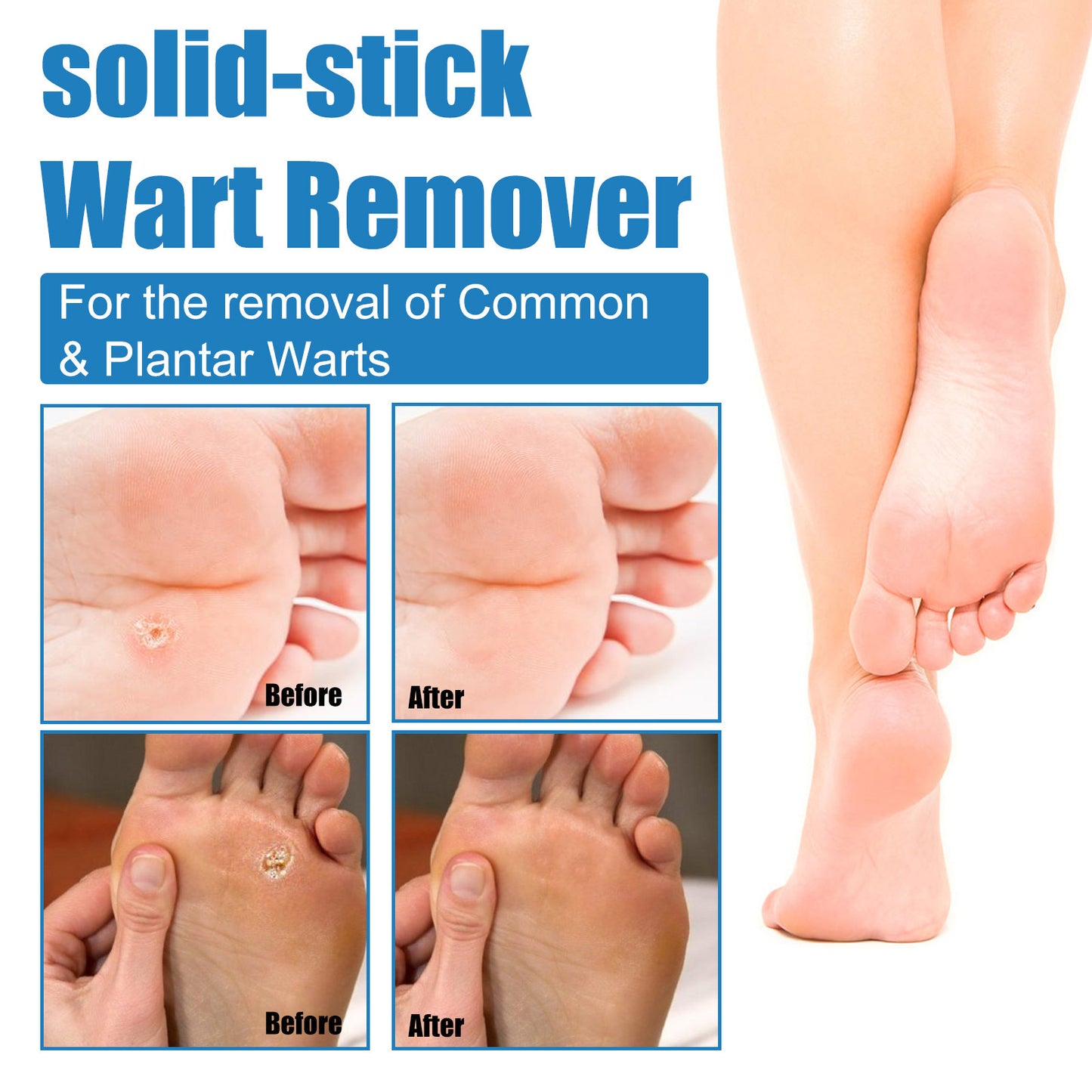 HZA ® Warts Remover Stick