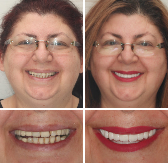 HZA™ --🦷Advanced Customized Full Denture Set🦷 (⏰Limited time discount last 30 minutes⏰)
