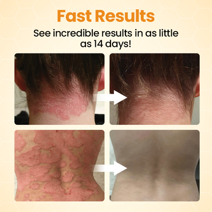 LOVILDS™ Bee Poison Psoriasis Skin Care