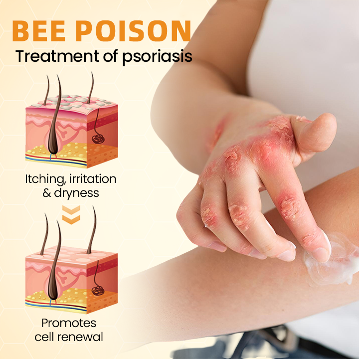 LOVILDS™ Bee Poison Psoriasis Skin Care